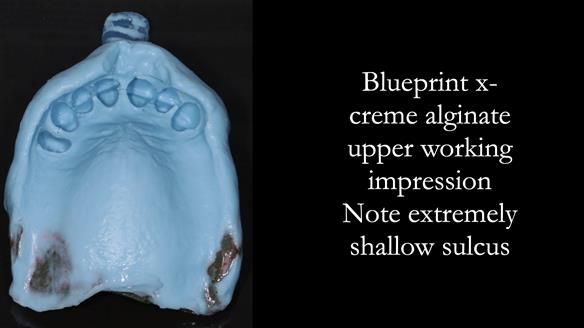 Newsletter 56 showing the making and fitting of a bilateral free end saddle upper removable partial denture (RPD) for patient with pemphigus