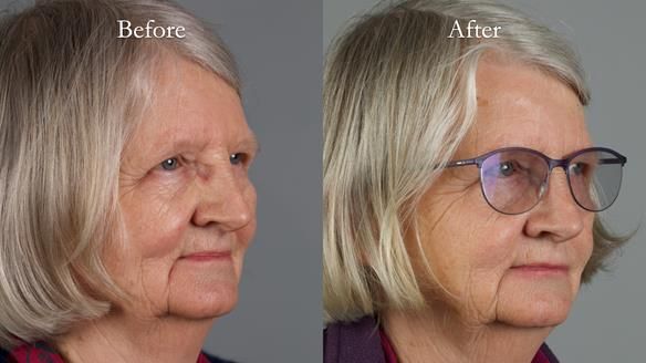 Newsletter 82 Mary - A complete upper and a one-tooth gasket denture