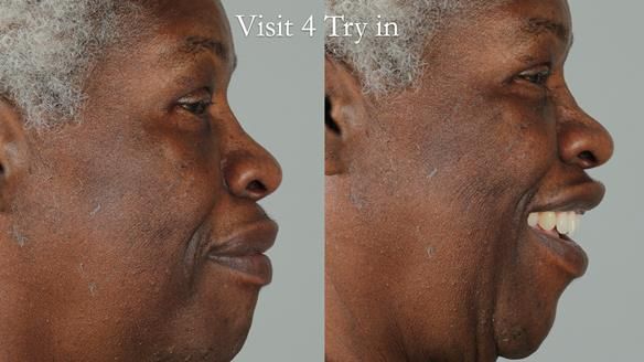 Newsletter 53 showing the making and fitting of ultra life-like dentures for Valena