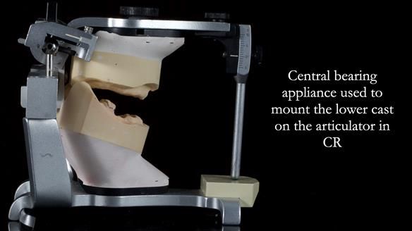 Newsletter 82 Mary - A complete upper and a one-tooth gasket denture