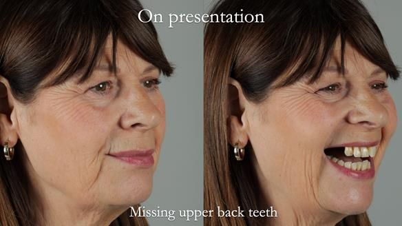 Newsletter 56 showing the making and fitting of a bilateral free end saddle upper removable partial denture (RPD) for patient with pemphigus
