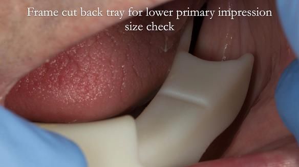 Complete denture Class II div 2 deep overbite Newsletter 39