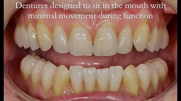 Newsletter 50 Special edition Complete Dentures FULL PROTOCOL