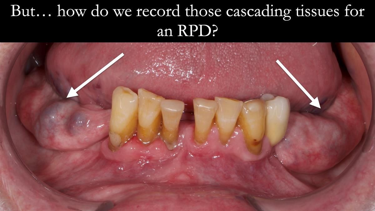 Newsletter 87 – Father Peter: A Partial Denture that needed Minor Miracle