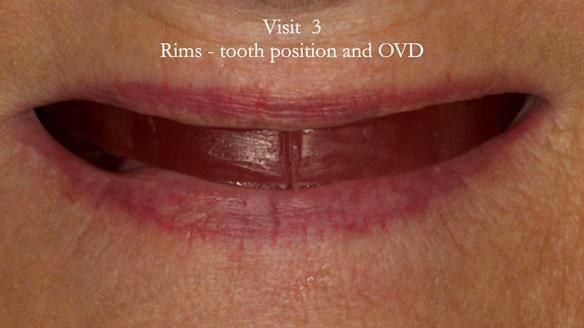 Visit 3 registration stage - prescribing the position of the upper teeth and the correct occlusal vertical dimension