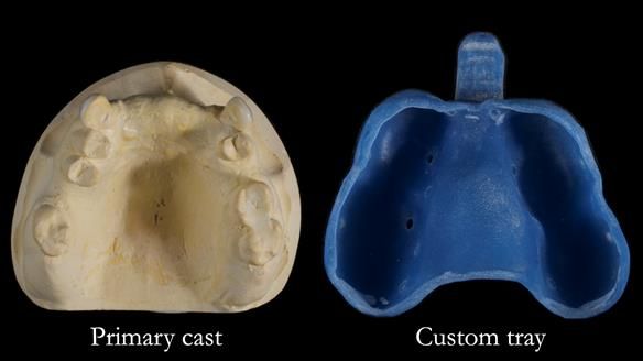 Newsletter 81 - Pam’s Story — how a partial denture changed her life (+ live walkthrough this Thursday)