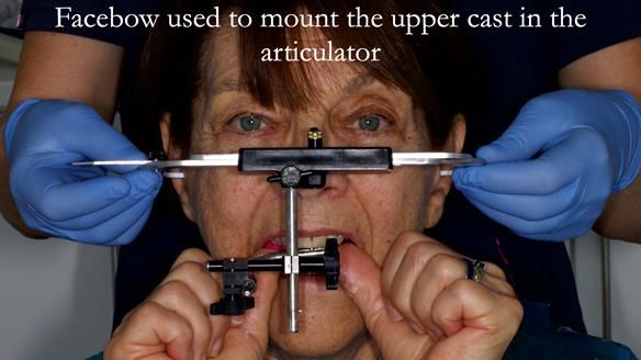 Finlay's Newsletter 61 provision of a lower unilateral free end saddle metal based partial denture for Joyce