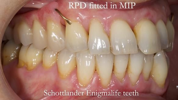 Newsletter 56 showing the making and fitting of a bilateral free end saddle upper removable partial denture (RPD) for patient with pemphigus
