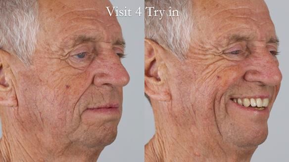 Newsletter 54 case presentation upper complete denture and lower Scandinavian designed hygienic partial denture for David