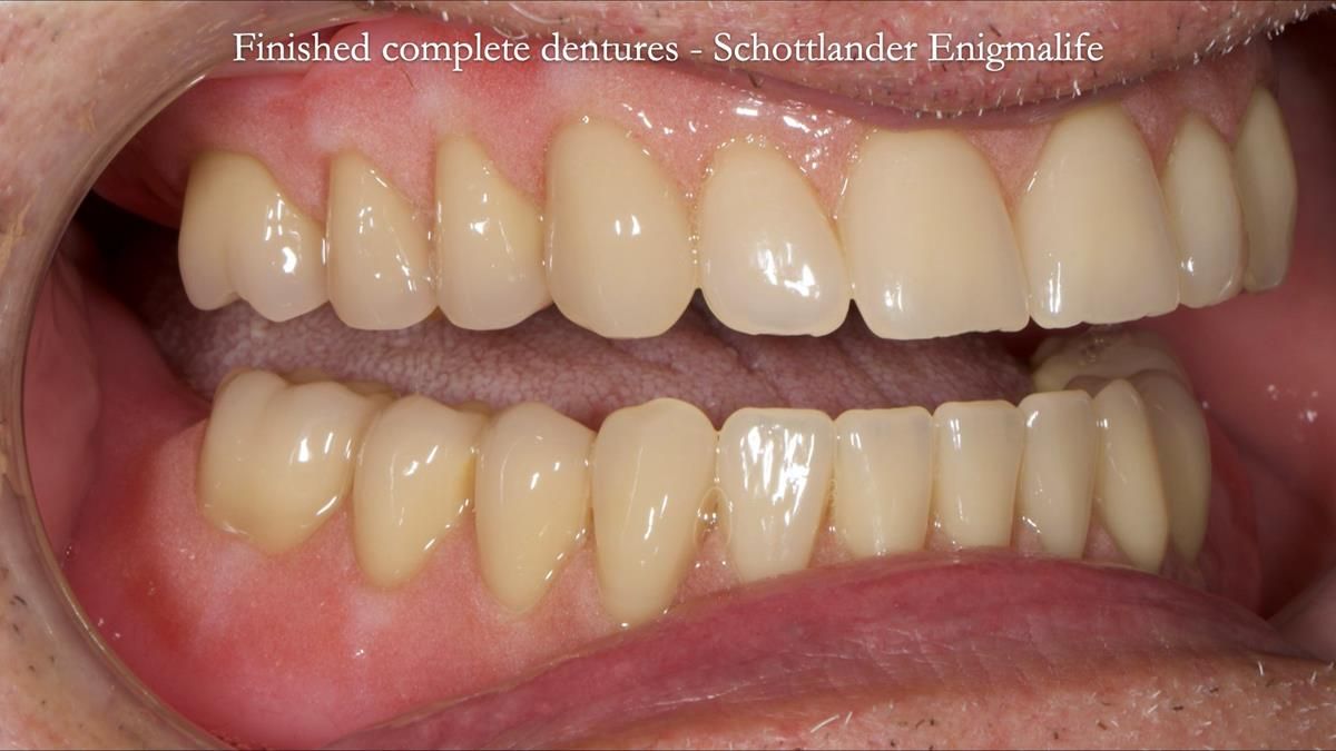 Fin’s Newsletter 88 — Complete dentures - full protocol… he rearranged his own teeth!