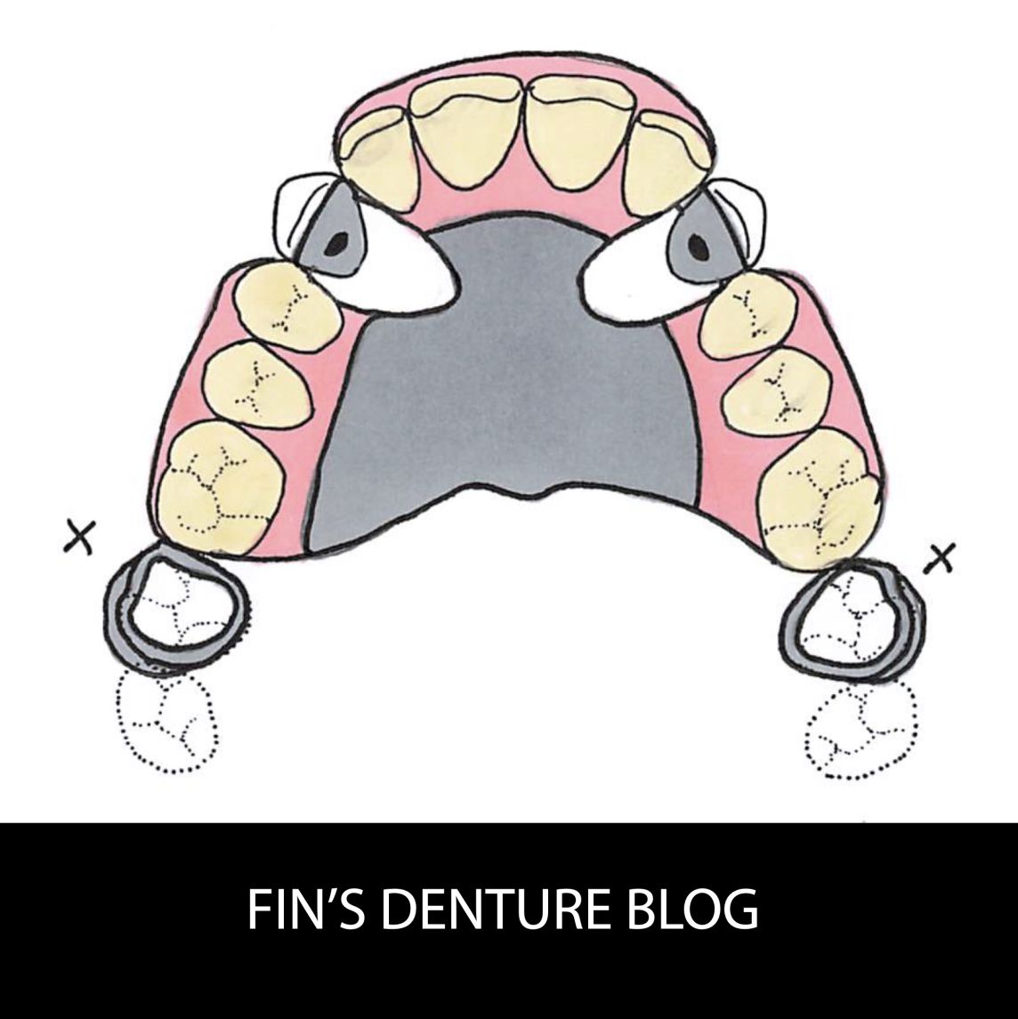 Big clear designs for partial dentures