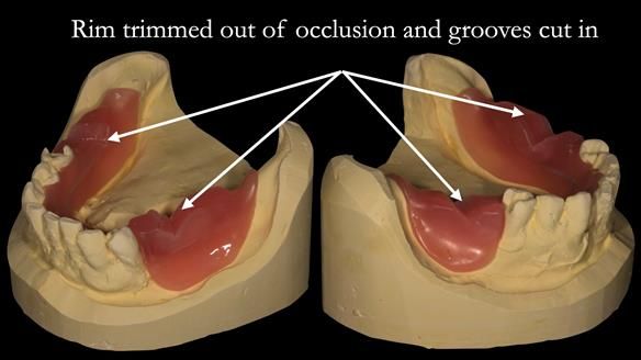 Finlay's Case Study Newsletter 40 - Immediate Mk 1 RPD to Definitive Mk 2 RPD - full protocol