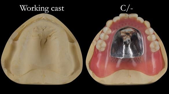 Newsletter 50 Special edition Complete Dentures FULL PROTOCOL