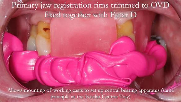 Finlay's Newsletter 59 Ultra hard partial dentures made for Gill