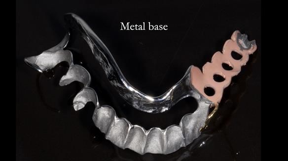 Finlay's Newsletter 61 provision of a lower unilateral free end saddle metal based partial denture for Joyce