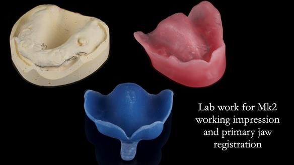 Newsletter 77: Jeremy’s case – immediate complete upper denture