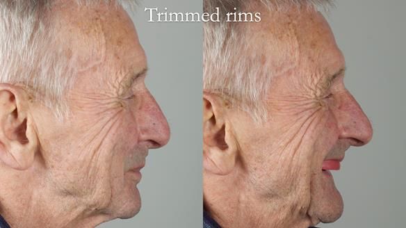 Newsletter 80 - Gordon’s dentures: the one case in 1,000 where my technique failed
