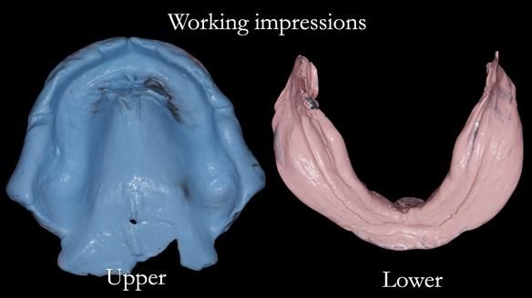 Newsletter 50 Special edition Complete Dentures FULL PROTOCOL