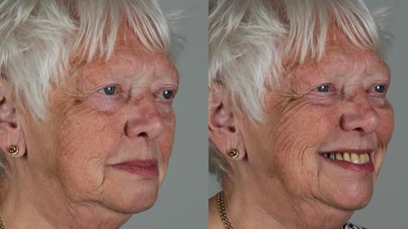 Finlay's Newsletter 59 Ultra hard partial dentures made for Gill