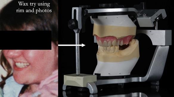 Finlay's Newsletter 58 Gasket upper partial denture for Zoe