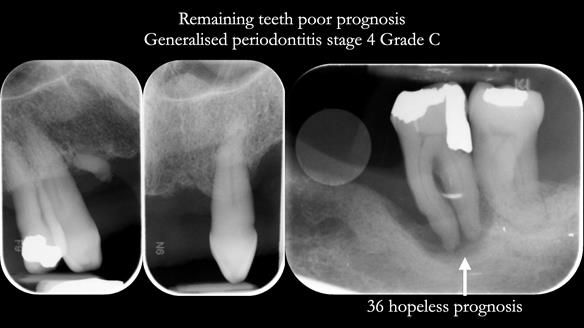 Finlay's Newsletter 59 Ultra hard partial dentures made for Gill