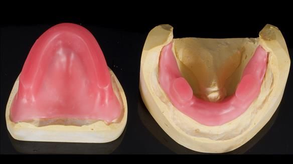 Newsletter 80 - Gordon’s dentures: the one case in 1,000 where my technique failed