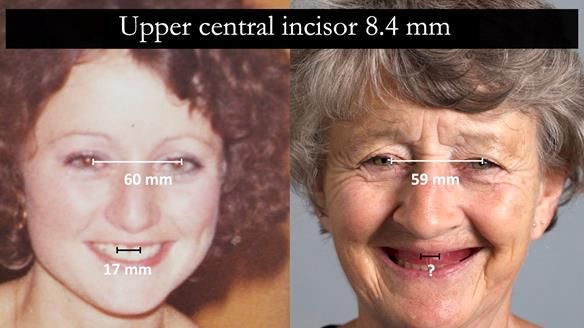 Solving Linda’s Failed “All on 4” implant bridges - full protocol Newsletter 42