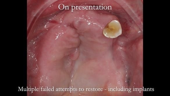Newsletter 55 Provision of metal based partial dentures for Zephyrine with a repaired cleft lip and palate