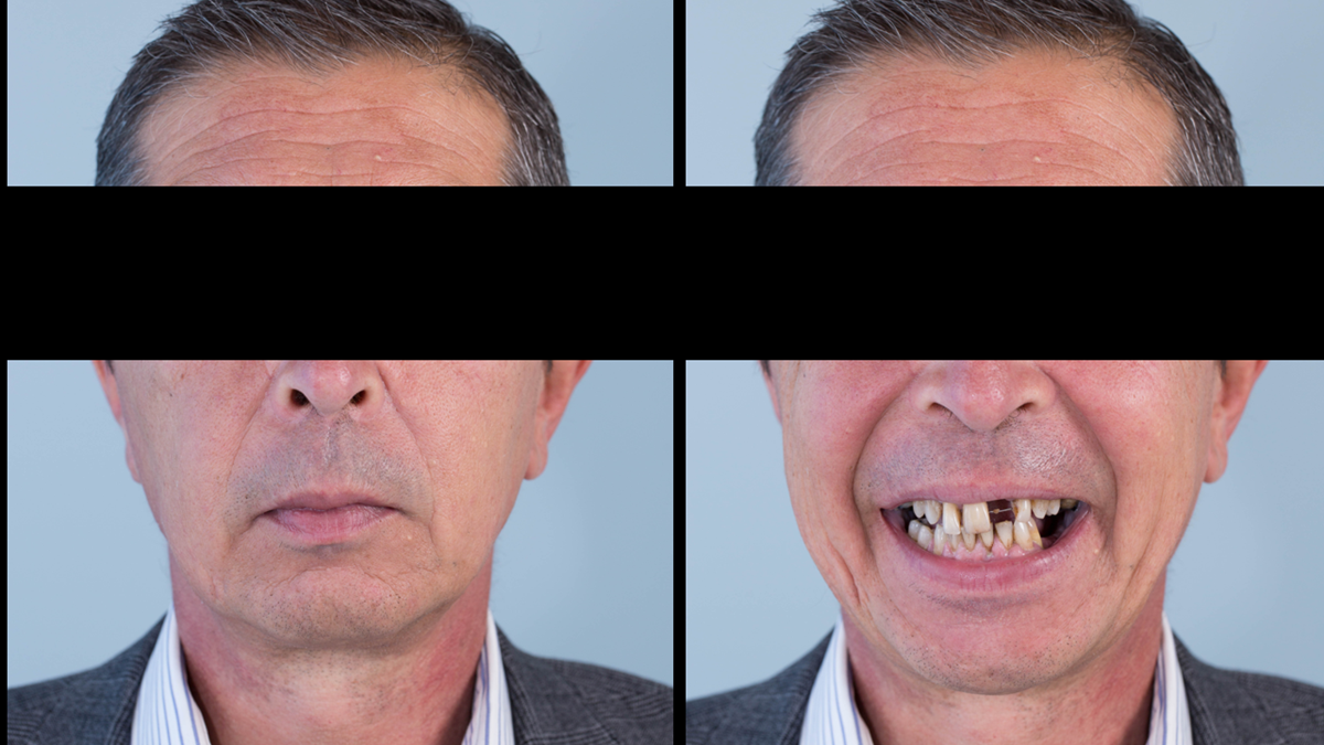 Figure 1 Pre-treatment with generalised periodontitis; stage IV grade C, unstable, risk factors: smoker. Prior to phase one treatment of immediate complete upper denture and immediate mandibular acrylic based partial denture.