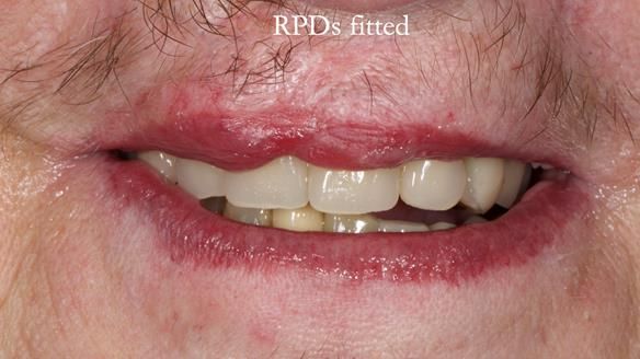 Newsletter 55 Provision of metal based partial dentures for Zephyrine with a repaired cleft lip and palate