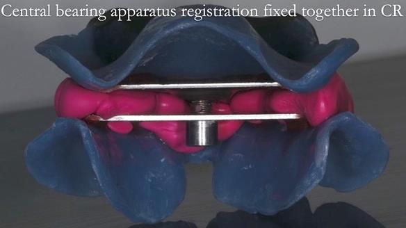 Newsletter 53 showing the making and fitting of ultra life-like dentures for Valena