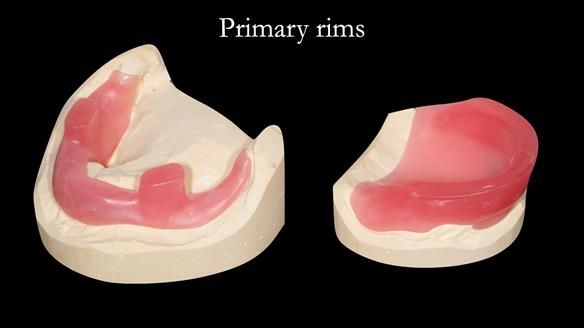 Managing poor implant positioning with complete dentures and Locator attachments - full protocol Newsletter 41