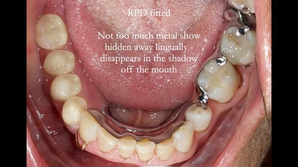 Finlay's Newsletter 61 provision of a lower unilateral free end saddle metal based partial denture for Joyce