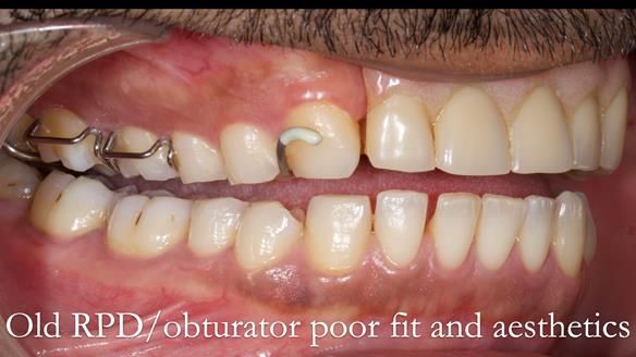 Acrylic based partial denture/obturator had poor, retention and support Obturator section was in poor condition. The Adams clasp were causing inflammation of the gingival margins. The clasp on the UR3 was visible resulting in poor appearance. Reduced lip