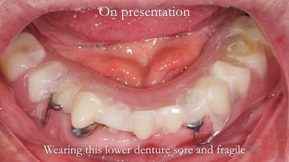 Newsletter 44 - extreme removable prosthodontics – engineering a super-strong and ultra-thin over denture