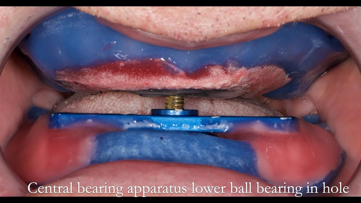 Fin’s Newsletter 88 — Complete dentures - full protocol… he rearranged his own teeth!