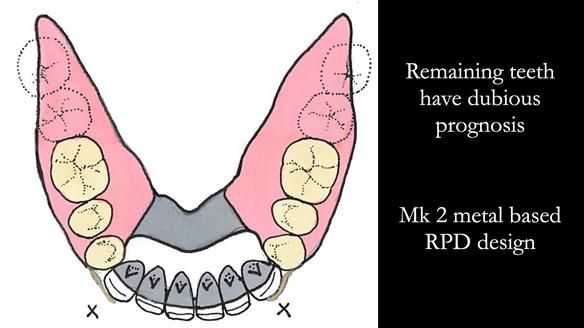 Newsletter 52 Managing Jo’s failing dentition with extractions and Mk 1/Mk 2 complete upper dentures and lower partial dentures FULL PROTOCOL