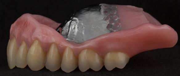 Figure 107 Mk 2 maxillary metal based denture with subtlety characterised Schottlander Enigmalife teeth. Gum colouring - Vertex