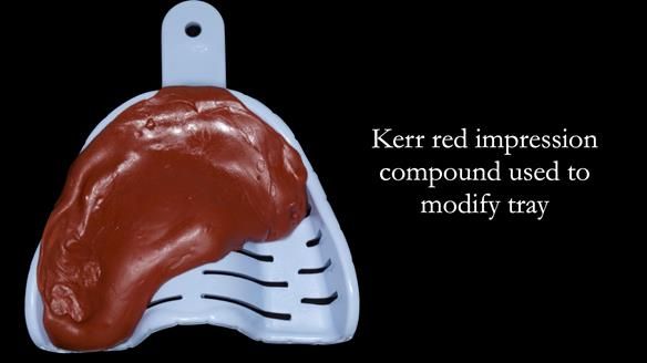 Newsletter 52 Managing Jo’s failing dentition with extractions and Mk 1/Mk 2 complete upper dentures and lower partial dentures FULL PROTOCOL