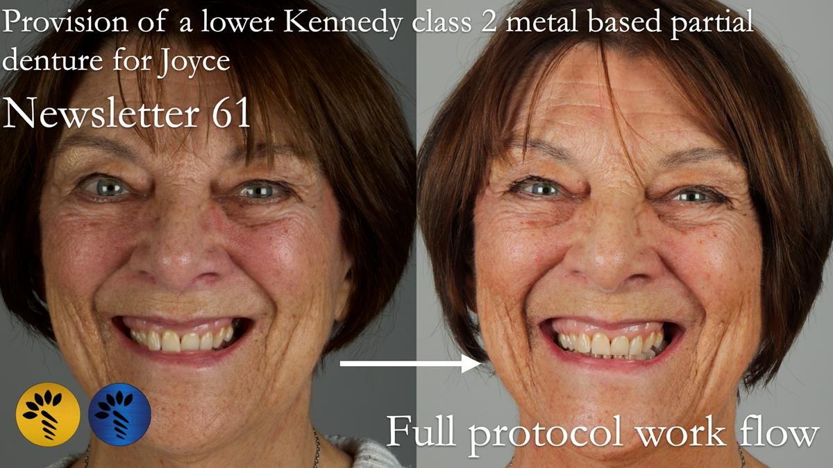 Finlay's Newsletter 61 provision of a lower unilateral free end saddle metal based partial denture for Joyce