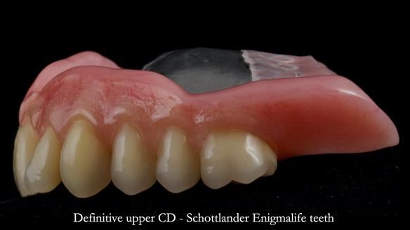 Newsletter 82 Mary - A complete upper and a one-tooth gasket denture