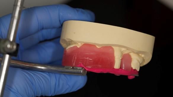 Eileen's transformation with upper and lower RPDs of Scandinavian hygienic design FULL PROTOCOL