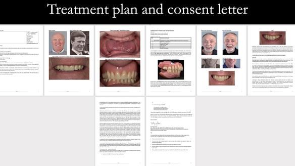 Complete denture Class II div 2 deep overbite Newsletter 39