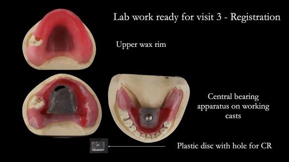 Newsletter 52 Managing Jo’s failing dentition with extractions and Mk 1/Mk 2 complete upper dentures and lower partial dentures FULL PROTOCOL