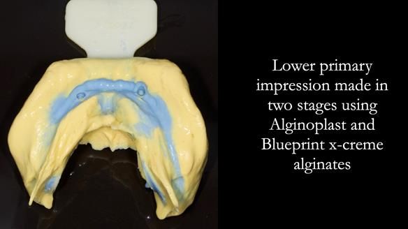 Newsletter 57 showcases the making and fitting process of implant-supported complete dentures for Alisdair