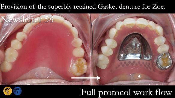 Finlay's Newsletter 58 Gasket upper partial denture for Zoe