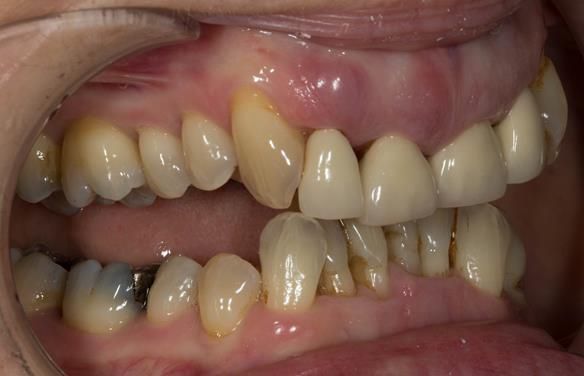 Figure 8 Overeruption of the upper and lower anterior segments with traumatic overbite and aesthetic failure