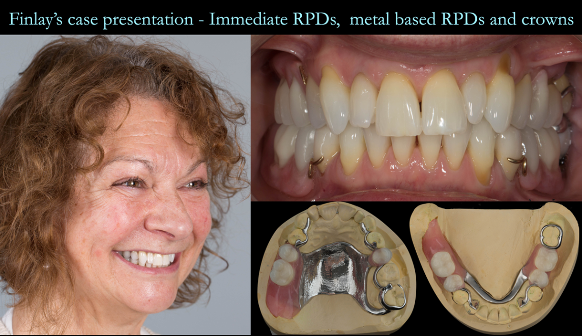 Finlay's fixed and removable prosthodontic case presentation of crowns and partial dentures