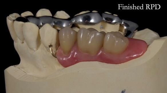 Finlay's Newsletter 64 case study - provision of a Kennedy class 2 metal based Scandinavian RPD for Ian