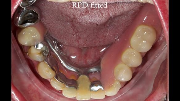 Newsletter 55 Provision of metal based partial dentures for Zephyrine with a repaired cleft lip and palate